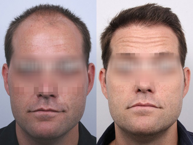 Hair Transplants in Hungary: How Much Are Hair Transplants in Hungary? 4 best hair transplants in Istanbul