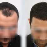 تكلفة زراعة الشعر في الجبل الأسود