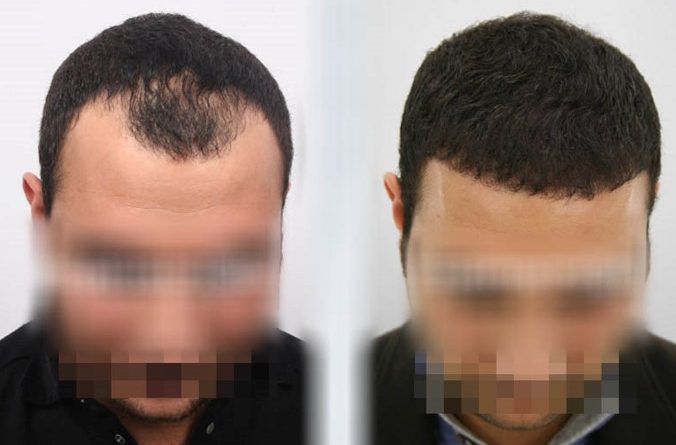 hair transplant montenegro cost