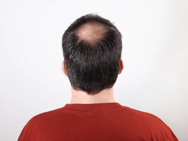 hair transplant cost montenegro
