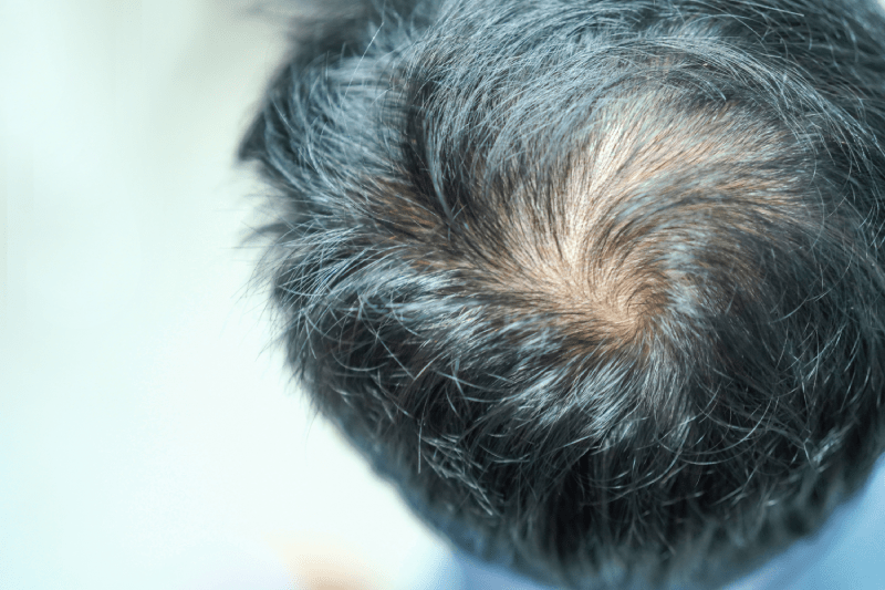 Hair Transplant Cost in Bulgaria 3 hair transplant turkey best costs