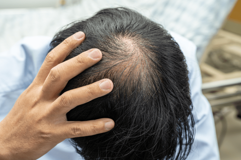 hair loss and hair transplant in turkey