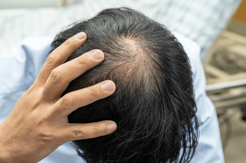 hair loss and hair transplant in turkey
