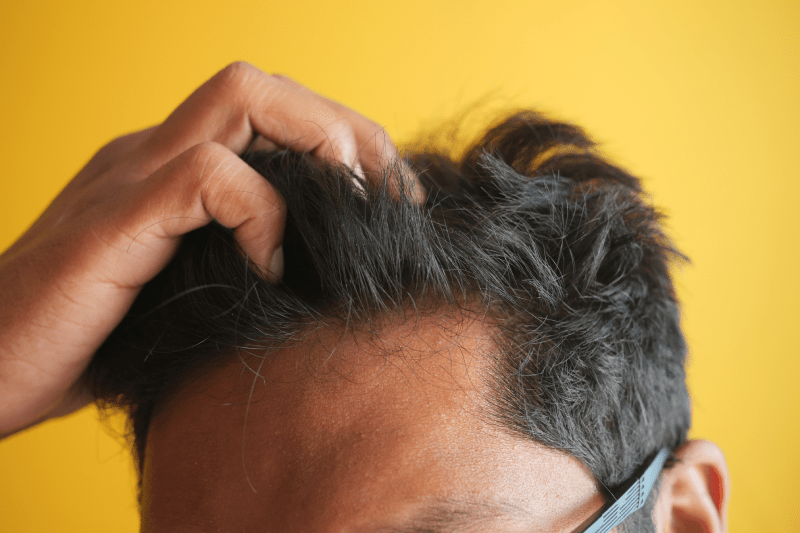 زراعة الشعر في تركيا