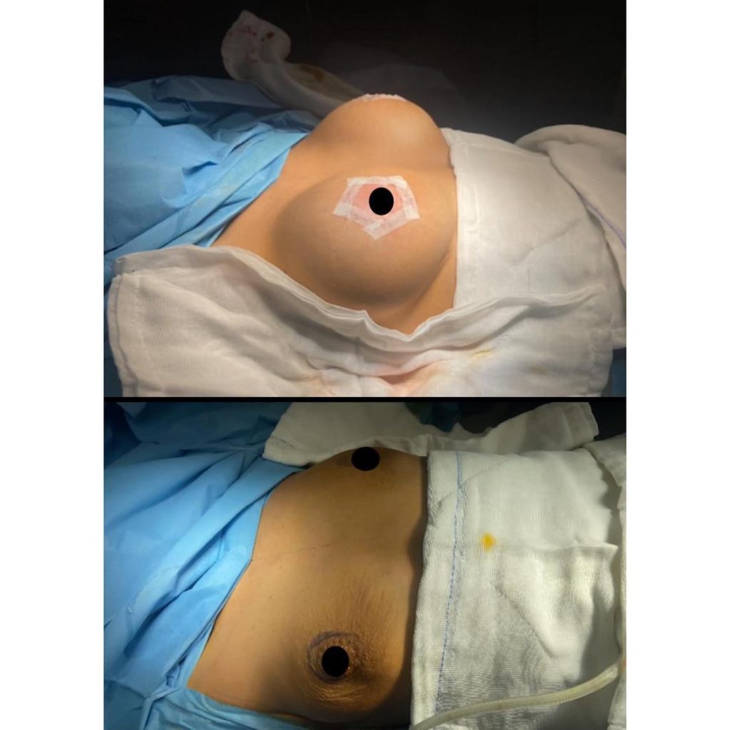 Breast Augmentation Surgeons in Turkey