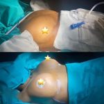 Breast Augmentation Surgeons in Turkey