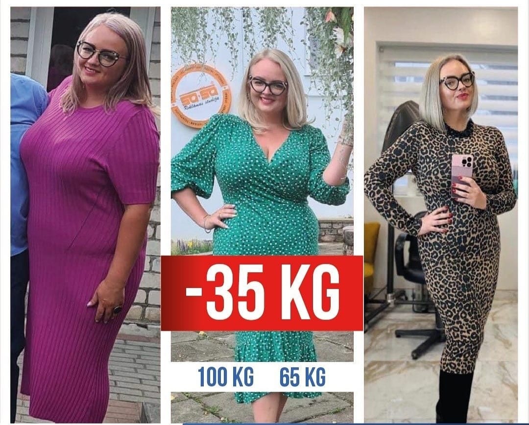 What Will Happen If Gastric Sleeve Doesn't Work? 4 vvs