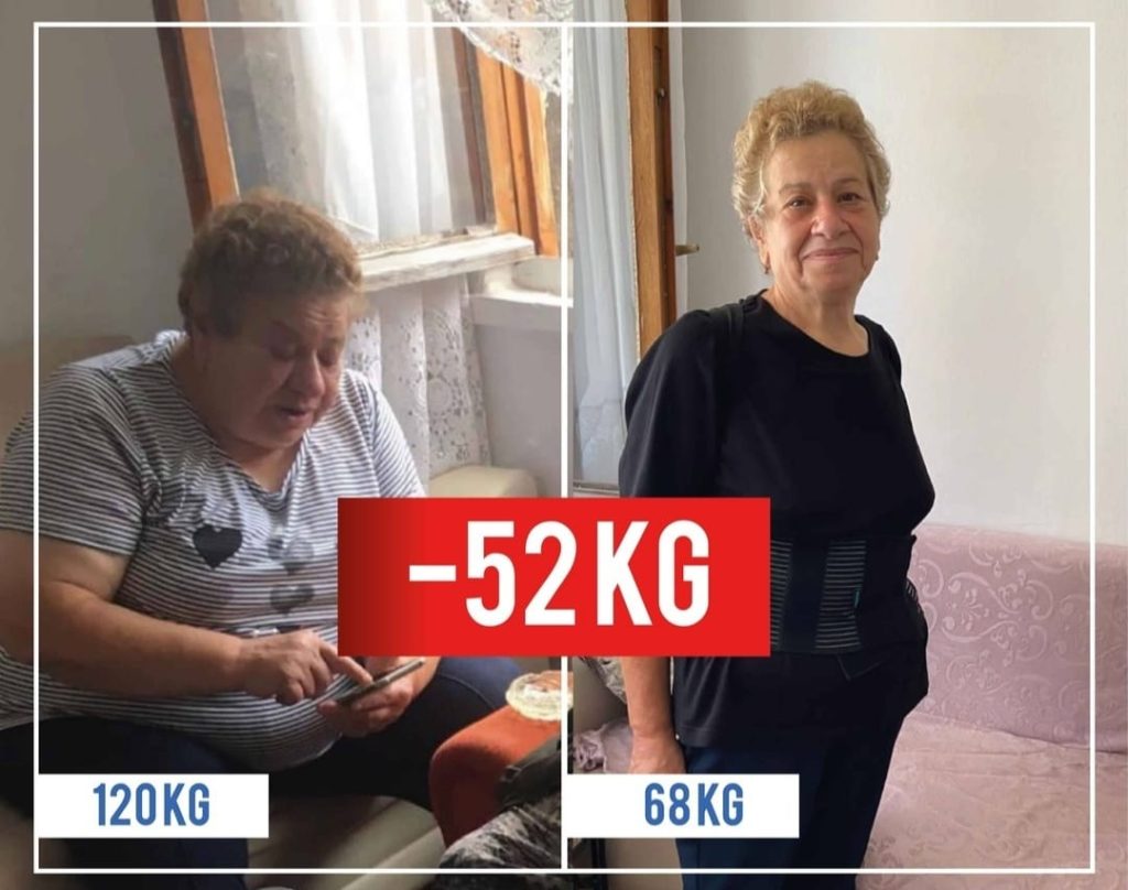How Much Is Gastric Sleeve in Turkey? 3 xa
