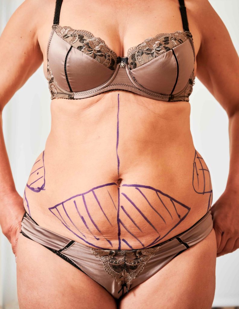 Tummy Tuck Turkey Reviews 2 woman body with marks for plastic surgery 2022 05 28 10 48 03 utc min