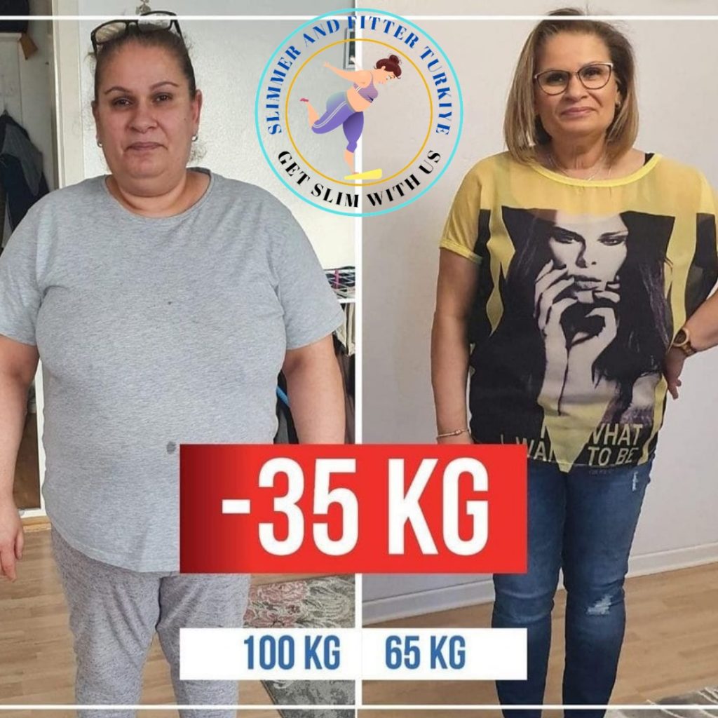 Gastric Sleeve Ispaniya va Turkiya