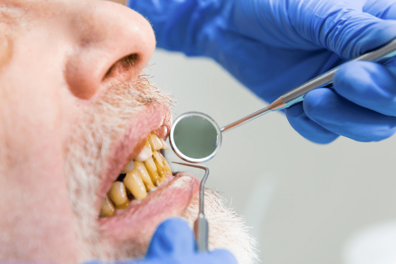Dental Veneers or Teeth Whitening? Procedure, Similarities, Differences and Cost Comparison 2023 2 Dental Veneers or Teeth Whitening