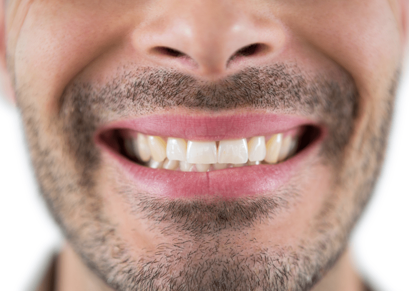 Hollywood Smile Antalya - Cost - Turkey Prices 2023 2 Hollywood Smile Antalya
