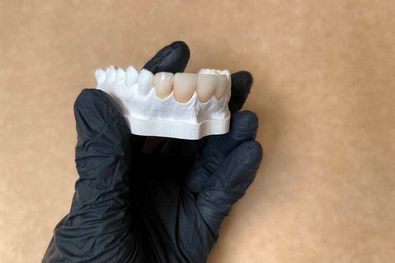Zirconium Dental Veneers or Porcelain in Kusadasi
