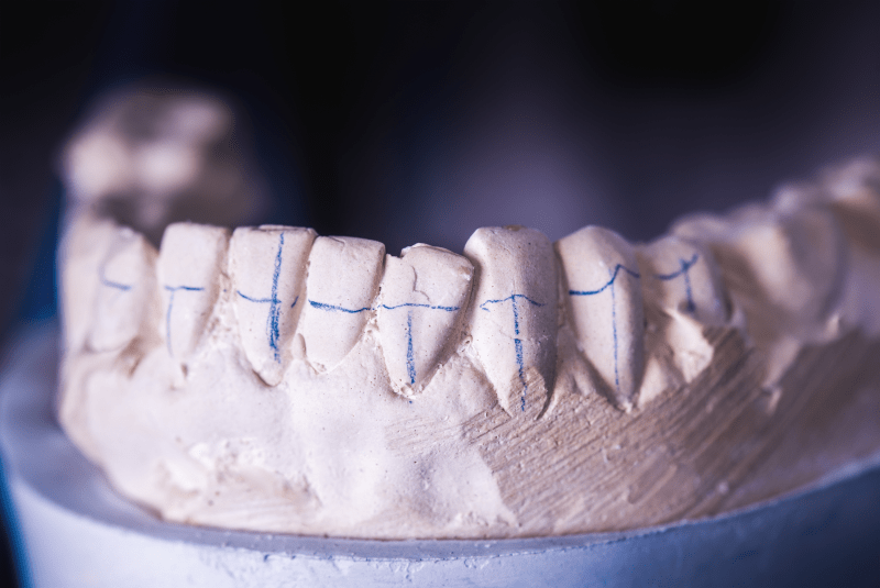 marques d'implants dentals