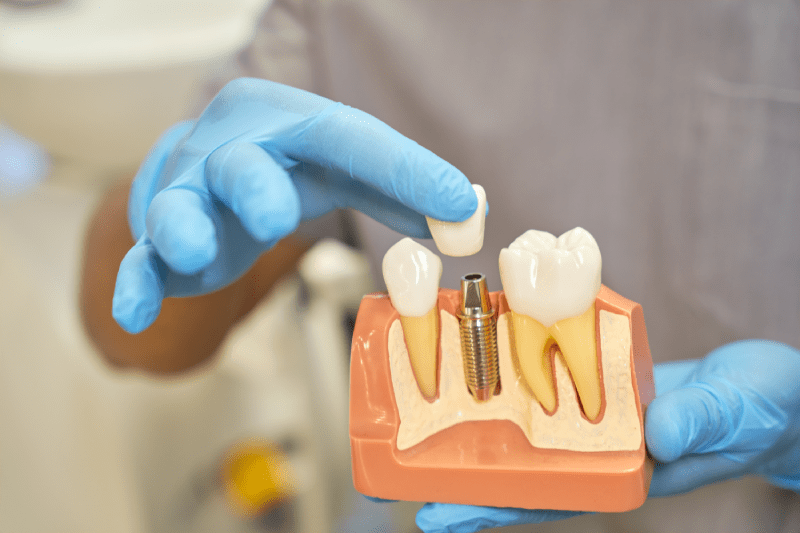 Diş implantları