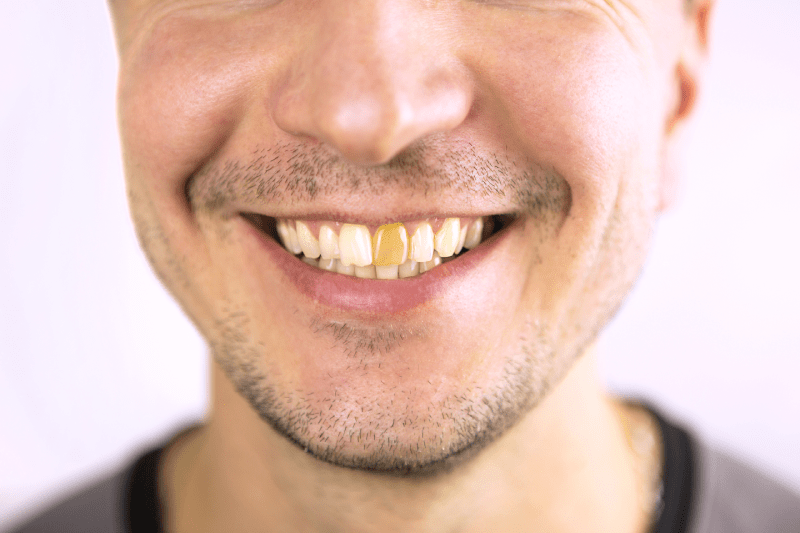 Why Does Tooth Yellowing Occur? Permanent Teeth Whitening Methods 3 Teeth Whitening