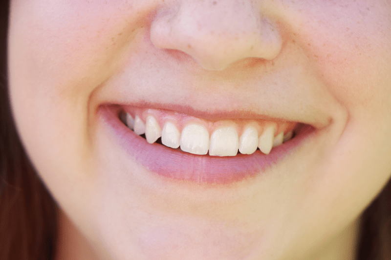 Izmir Cesme Hollywood Smile Aesthetics Clinic - Cesme Hollywood Smile Prices 2023 4 Hollywood Smile