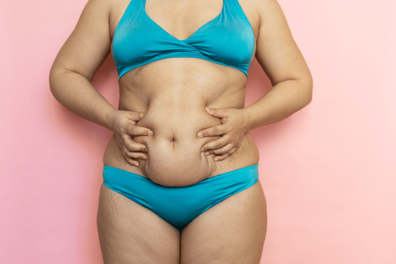 kempiskan perut atau liposuction