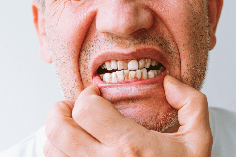 Why Does Tooth Yellowing Occur? Permanent Teeth Whitening Methods 2 Teeth Whitening