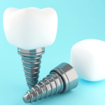 Dental Implant Brands Which Dental Implant Brand I Should Choose