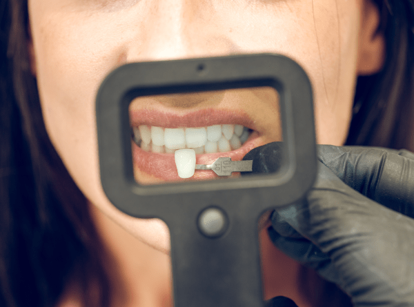 Perlakuan dental antara Inggris jeung Turki Harga Kontra jeung Pro