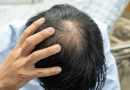 Hair Transplant UK nobis Turkey, Cons, Pros et Prices