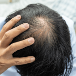 Hair Transplant UK vs Turkey Cons Pros and Prices