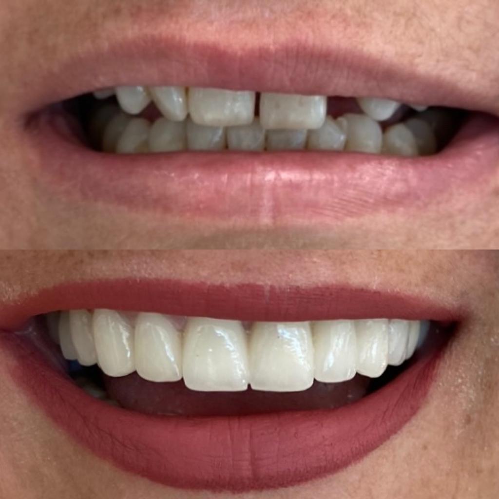 Izmir Cesme Hollywood Smile Aesthetics Clinic - Cesme Hollywood Smile Prices 2023 6 Hollywood Smile