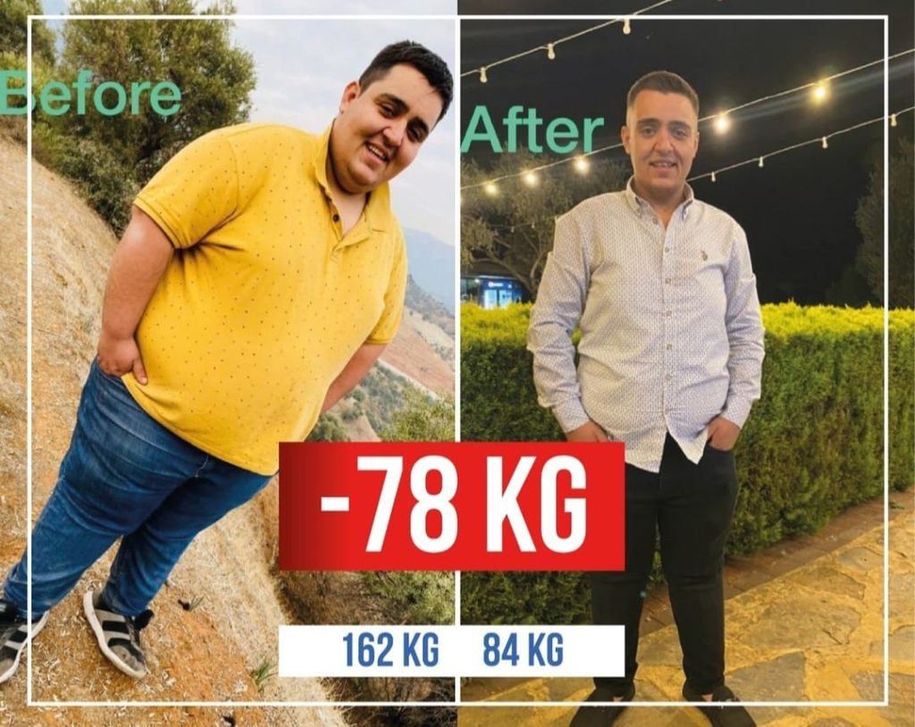 Gastric Sleeve Ispaniya va Turkiya