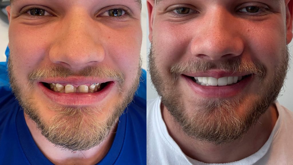 Турски стоматолошки фурнири пред - потоа