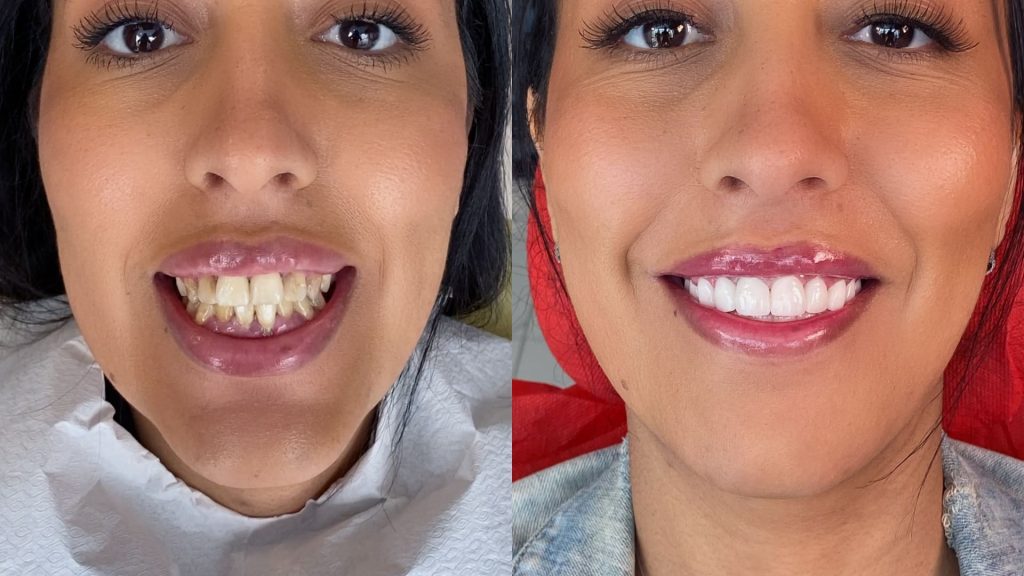 Турски стоматолошки фурнири пред - потоа