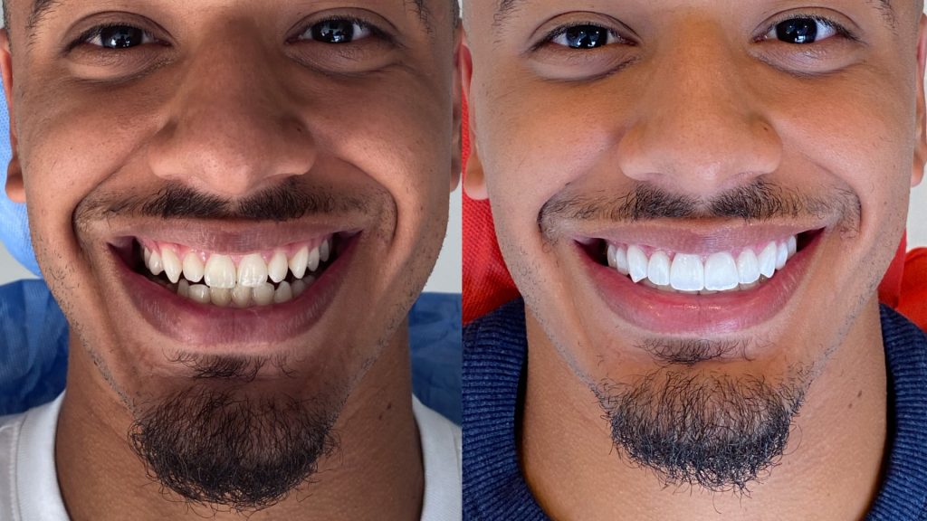 Hollywood Smile 3 exemple 8