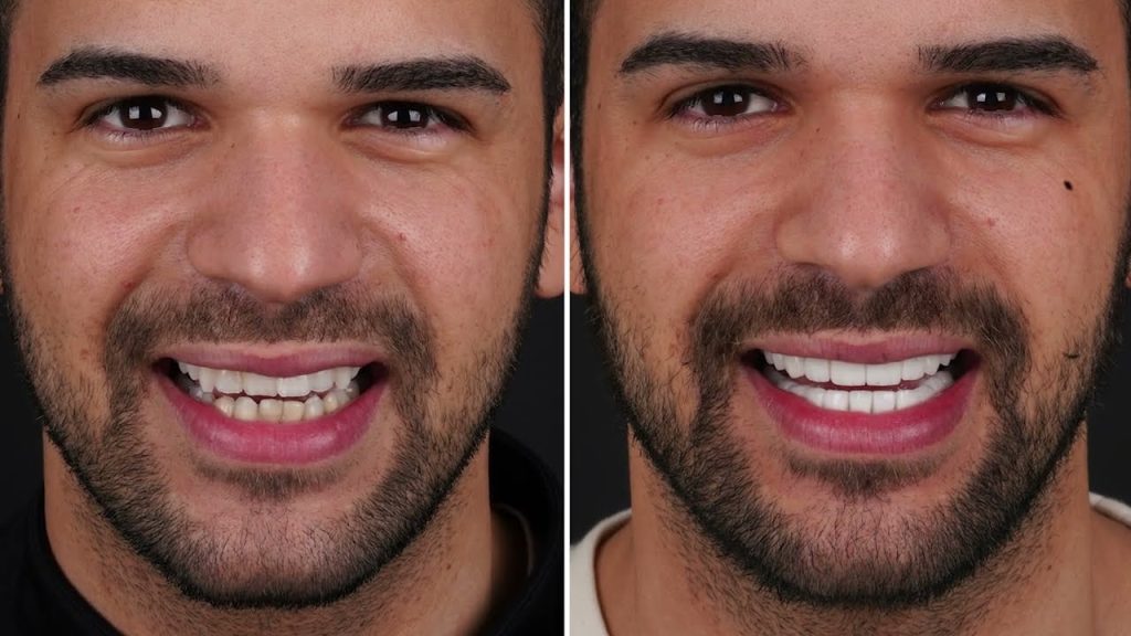 Turkey Dental Veneers ກ່ອນ - ຫຼັງ