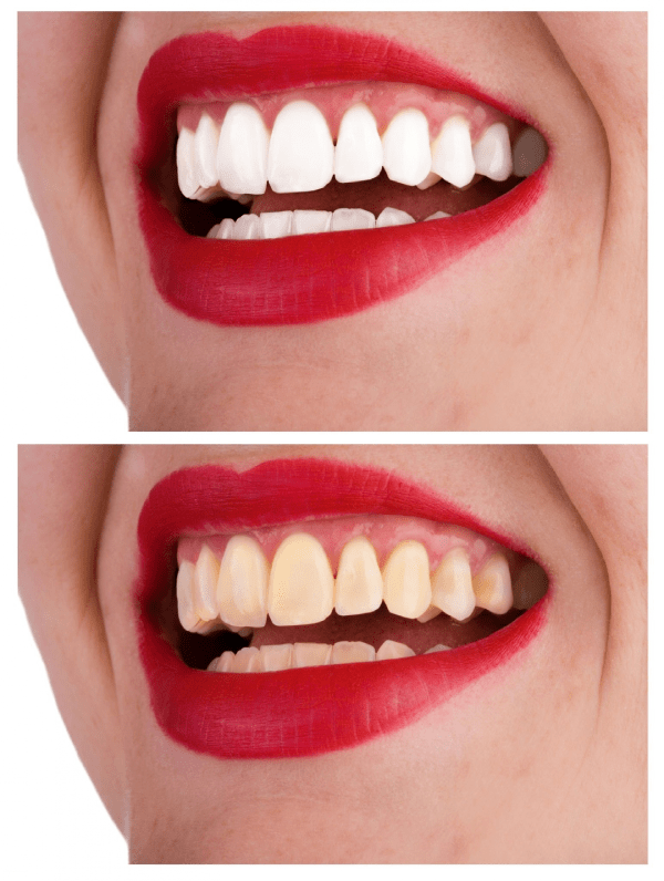 Teeth Whitening in Turkey: Pros and Cons, Before and After 5 Before and After Teeth Whitening in Turkey