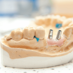 Dental Implants in Georgia