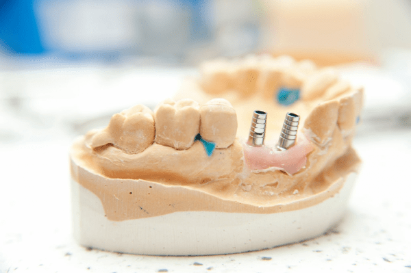 Implants nify sy dentures