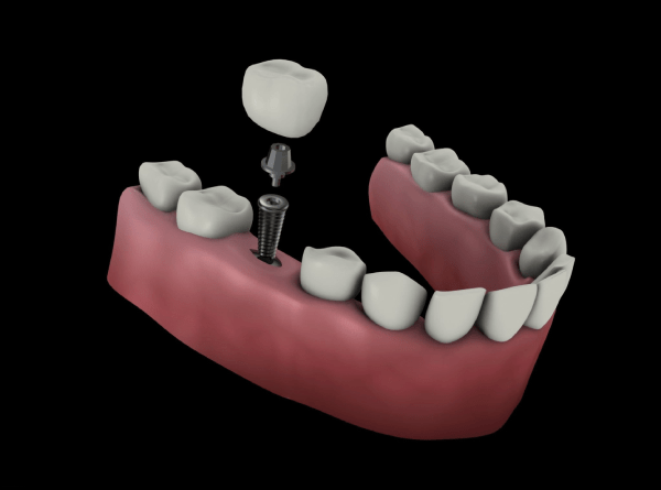 Ryzyko związane z implantami dentystycznymi