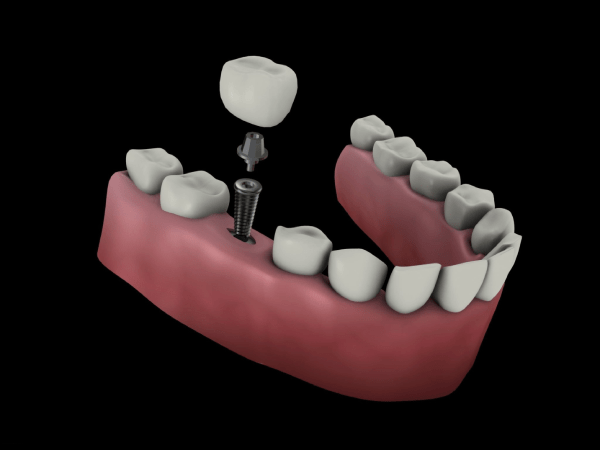 歯科インプラントのリスク