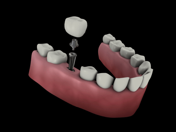 Complicacions dels implants dentals