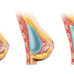 Breast Augmentation Surgery in Antalya