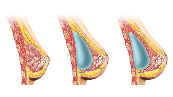 Cirurgia d'augment de mama a Antalya