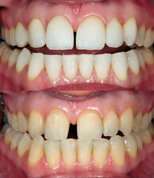 Antes e depois do clareamento dental na Turquia