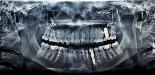 Dental Implant Complications