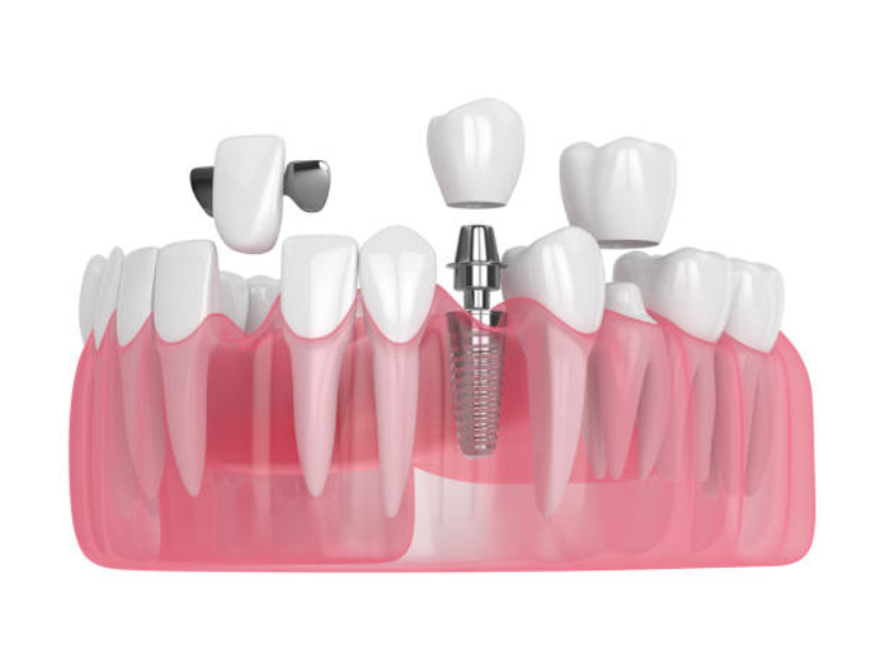 nirxandinên implantên diranan