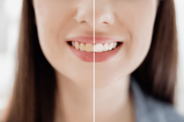 Teeth Whitening in Turkey: Pros and Cons, Before and After 1 Teeth Whitening in Turkey