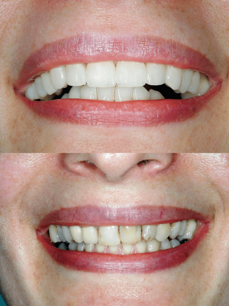 Turkye Tandheelkundige Veneers Voor - Na