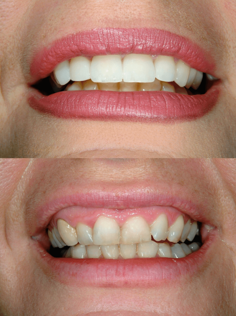 Turkey Dental Veneers Before - After