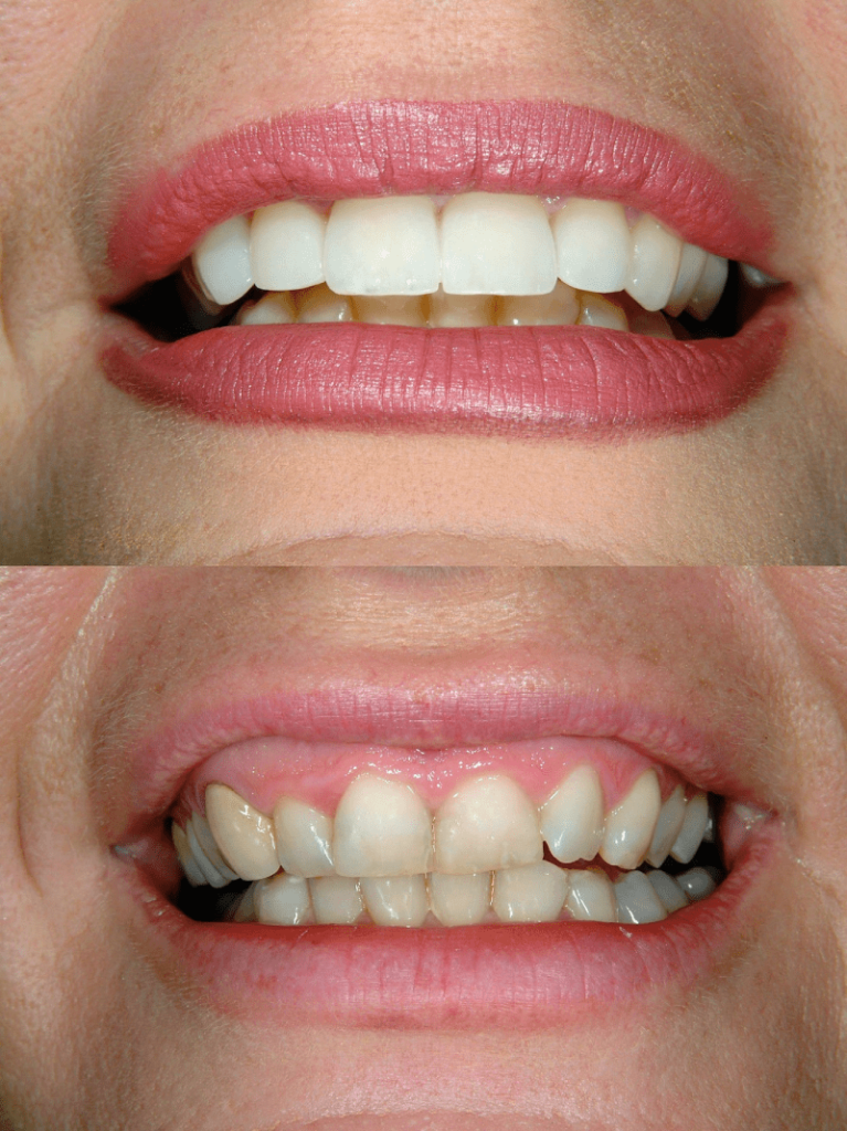 Zirconium Veneers Price UK 2023 - Zirconium Dental Veneers Advantages 7 Zirconium Veneers Price UK