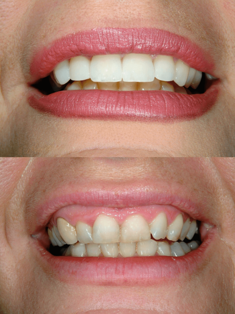 Turkye Tandheelkundige Veneers Voor - Na