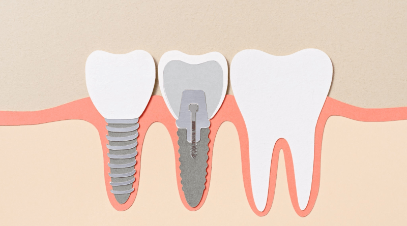 Dental Implants in Dublin Ireland